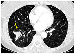 Diagnostics |-Text | Diagnostic Approach to Pulmonary B ...